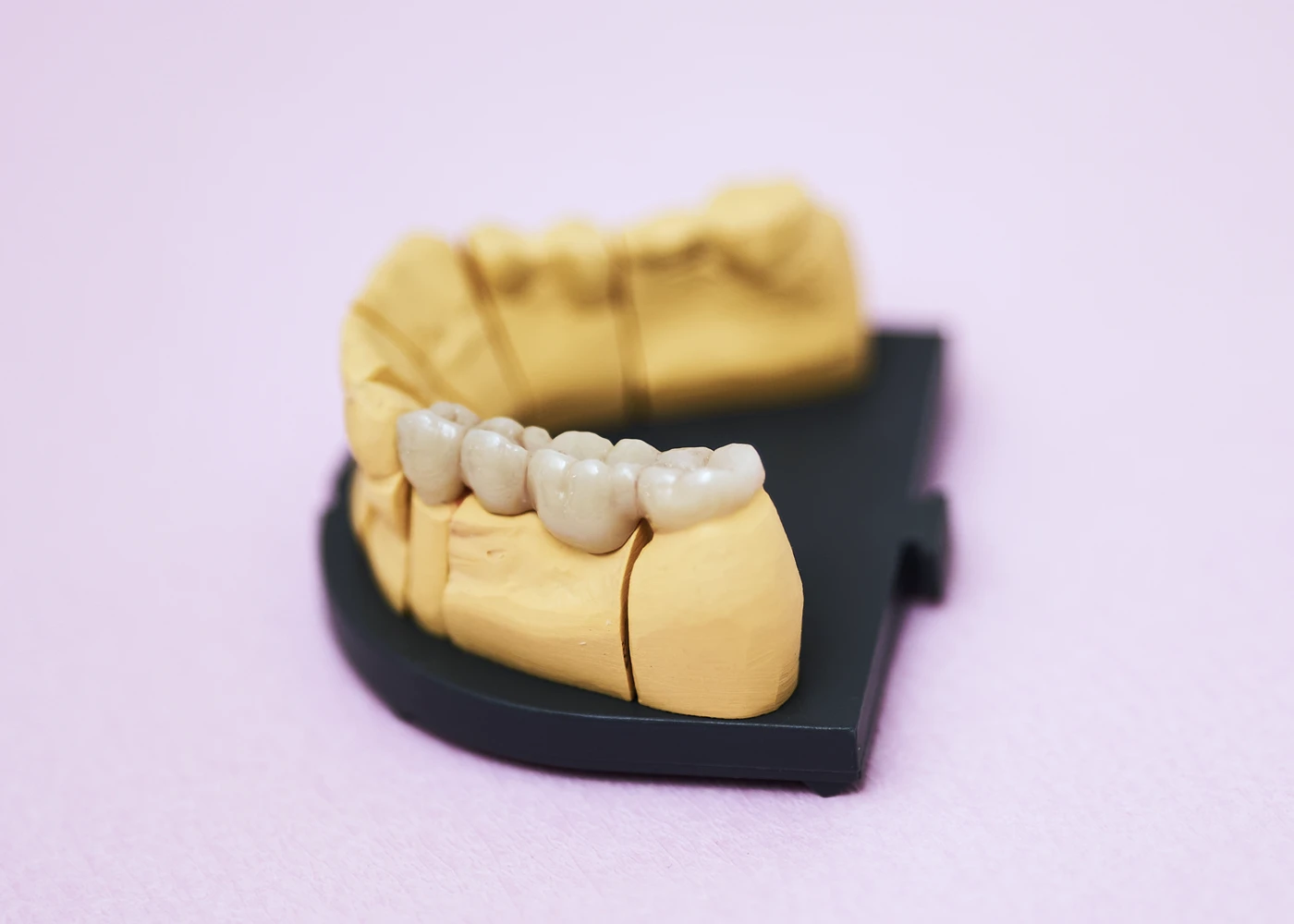 Zahnmodell zeigt Zahnersatz. Praxis Dr. Schmutz, Villingen-Schwenningen.